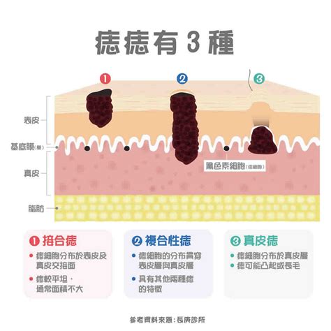 五歲長痣|痣形成的原因？痣長毛、痣變多變大是痣病變？5招判。